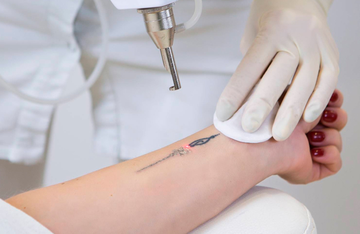 Eliminacion de Tatuajes con Laser 1