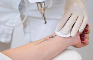 Eliminacion de Tatuajes con Laser 3